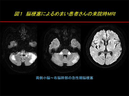 めまいとは 症状編 めまい 神経内科の主な病気 日本神経学会
